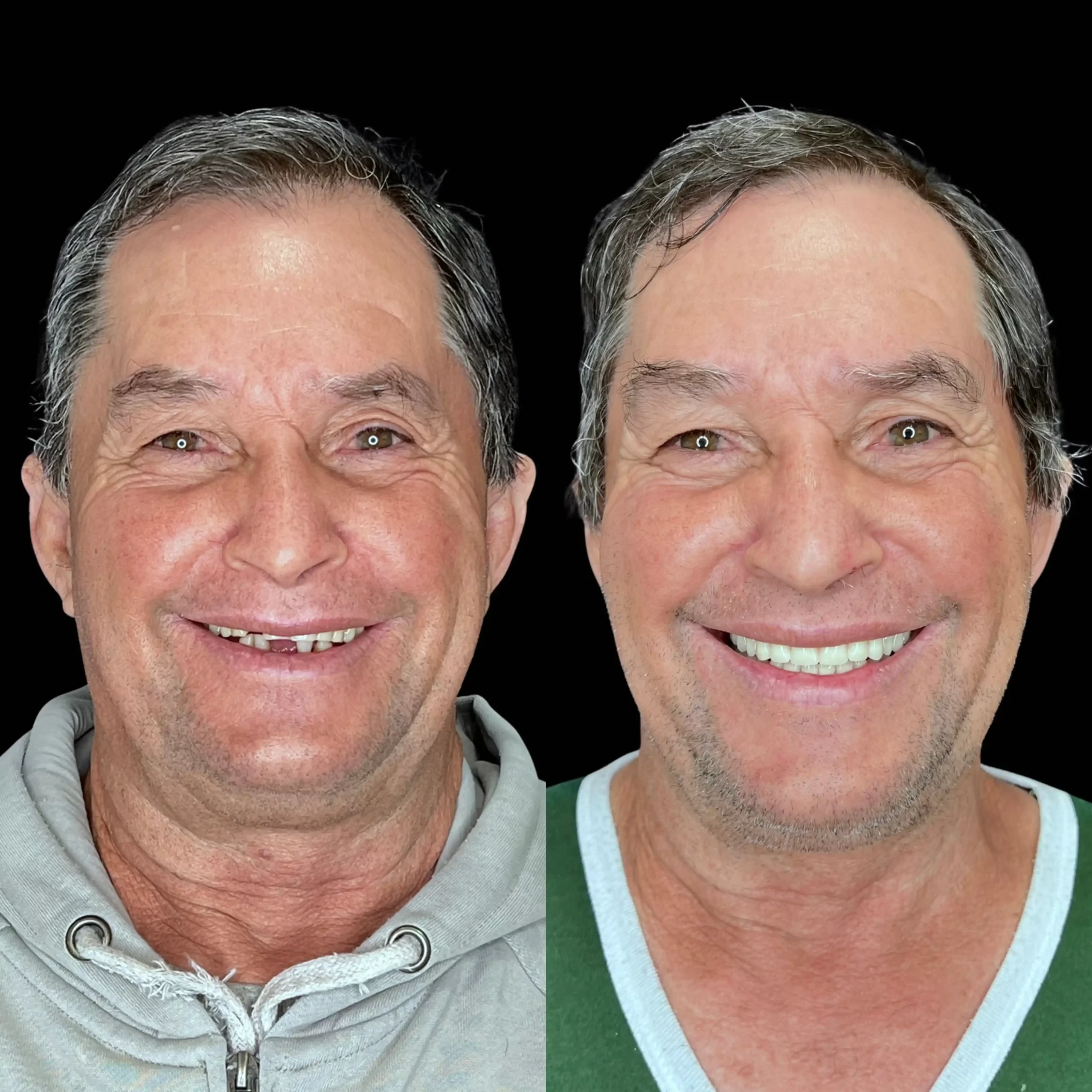 implantes dentários em campo grande ms