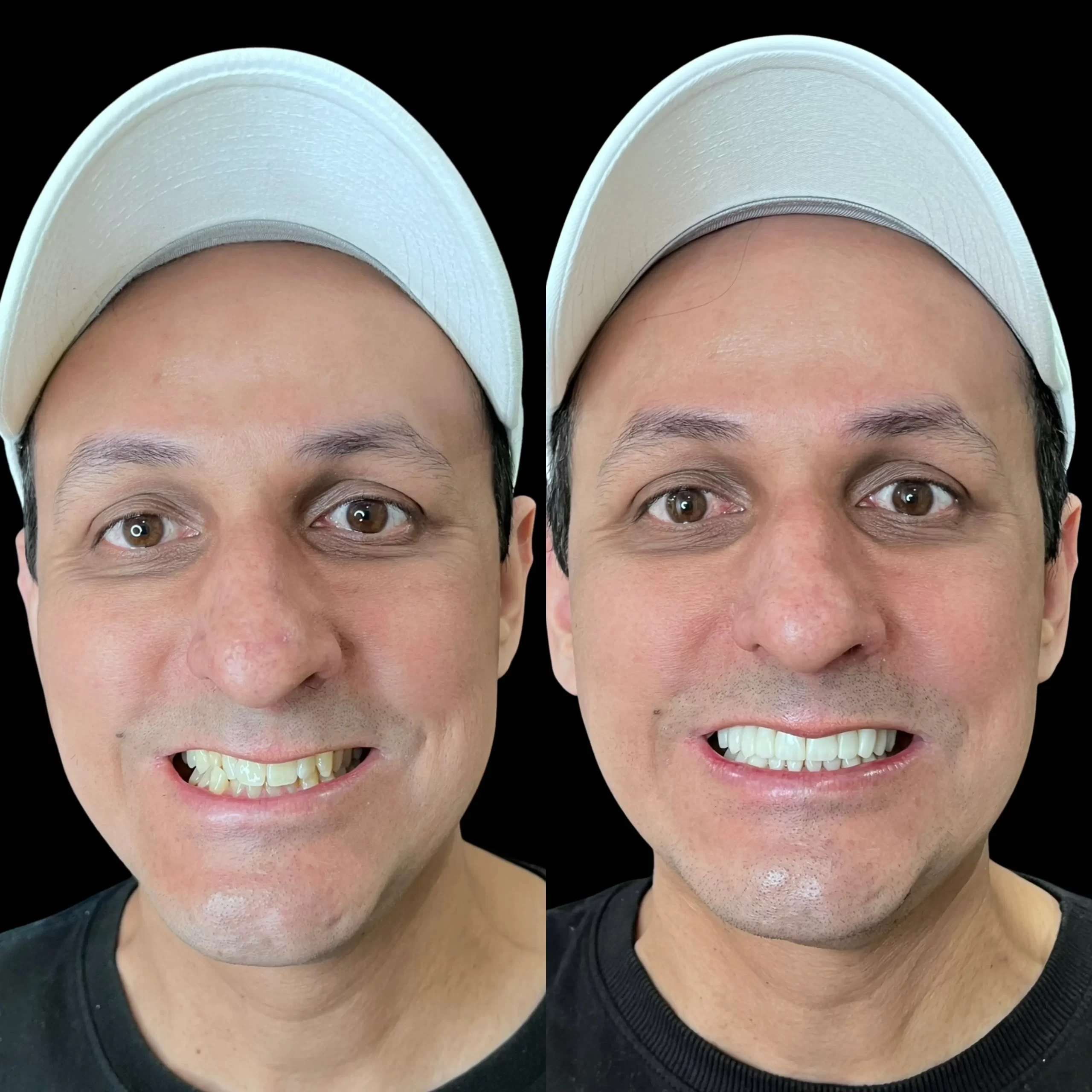 Facetas em resina campo grande ms