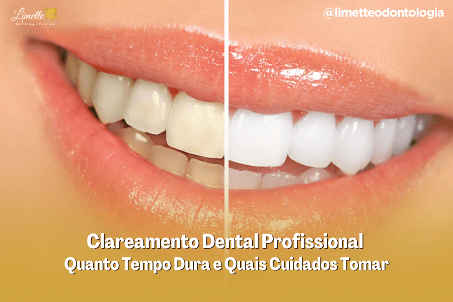 Quanto tempo dura o clareamento dental profissional?