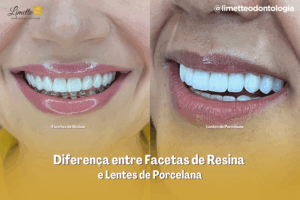 Diferenca entre Facetas de Resina