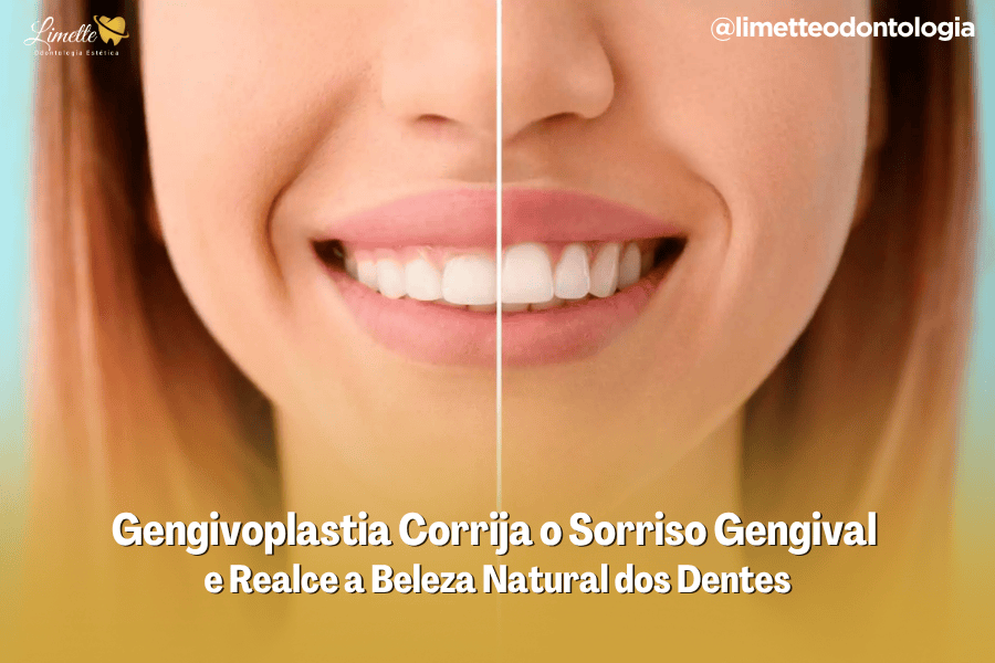 Gengivoplastia em Campo Grande – Corrija o Sorriso Gengival e Realce a Beleza Natural dos Dentes