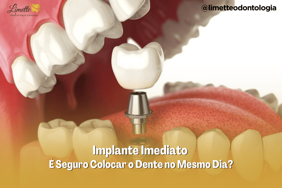 Implante imediato Campo Grande – Colocar o dente no mesmo dia é seguro?