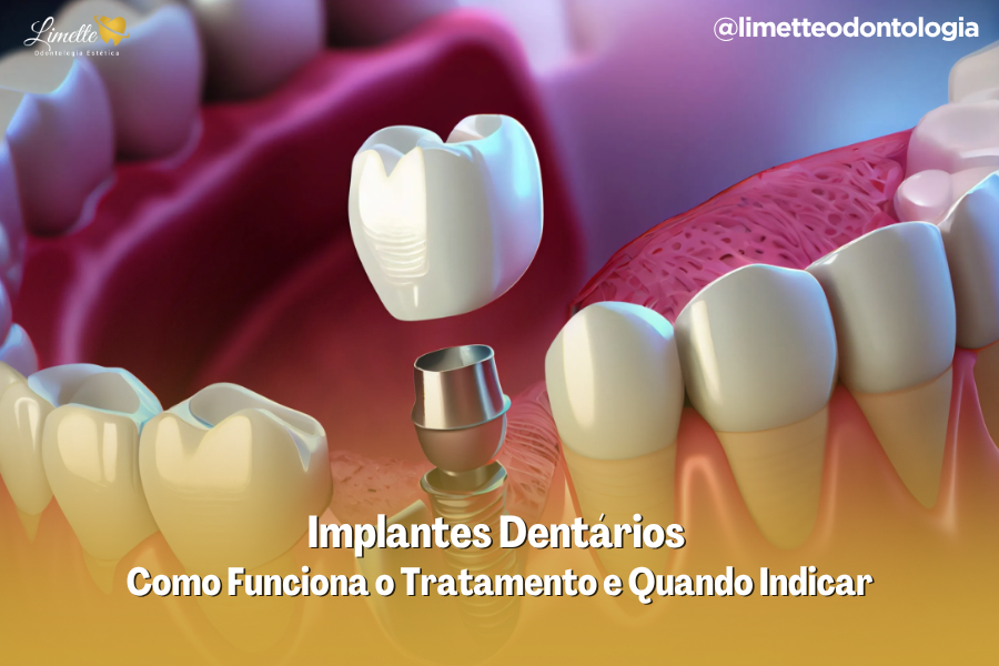 Implantes Dentarios em Campo Grande MS