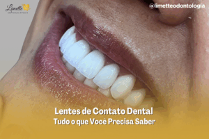 Lentes de Contato Dental em Campo Grande MS