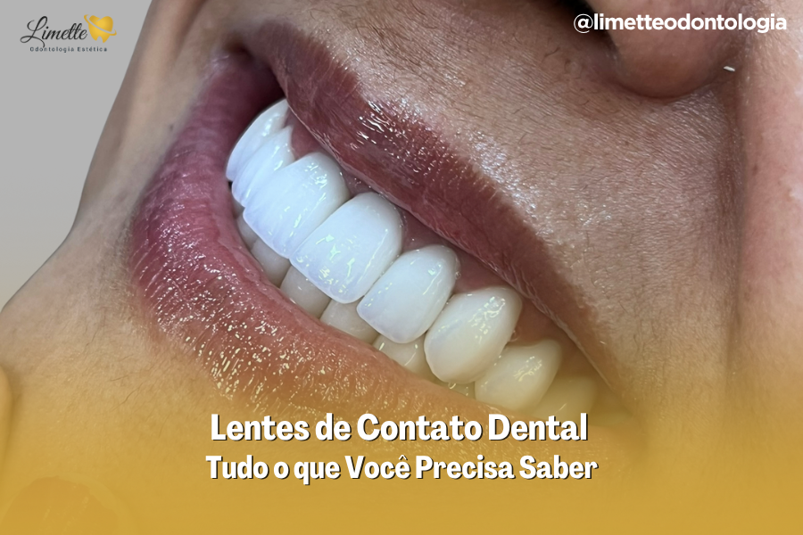 Lentes de Contato Dental em Campo Grande MS