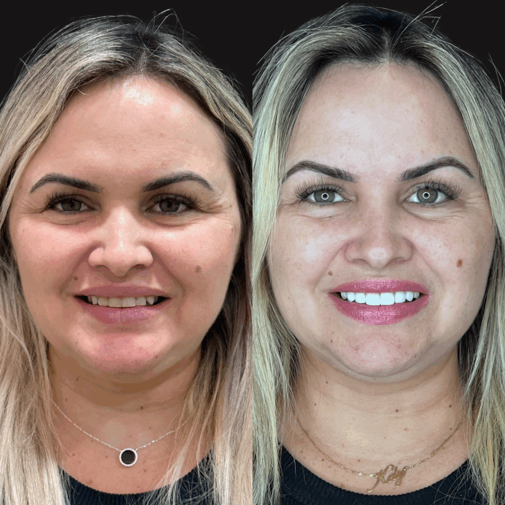 Lentes de Contato em campo grande