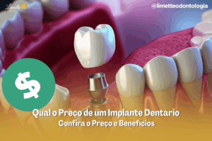 Qual o Preço de um Implante Dentário – Confira o Preço e Benefícios