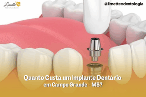 Quanto Custa um Implante Dentário em Campo Grande – MS?