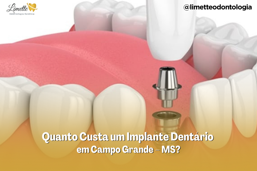 Quanto Custa um Implante Dentário em Campo Grande – MS?