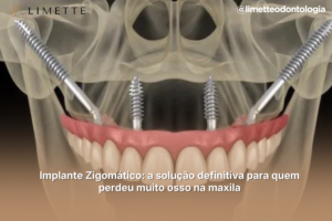 Implante Zigomático