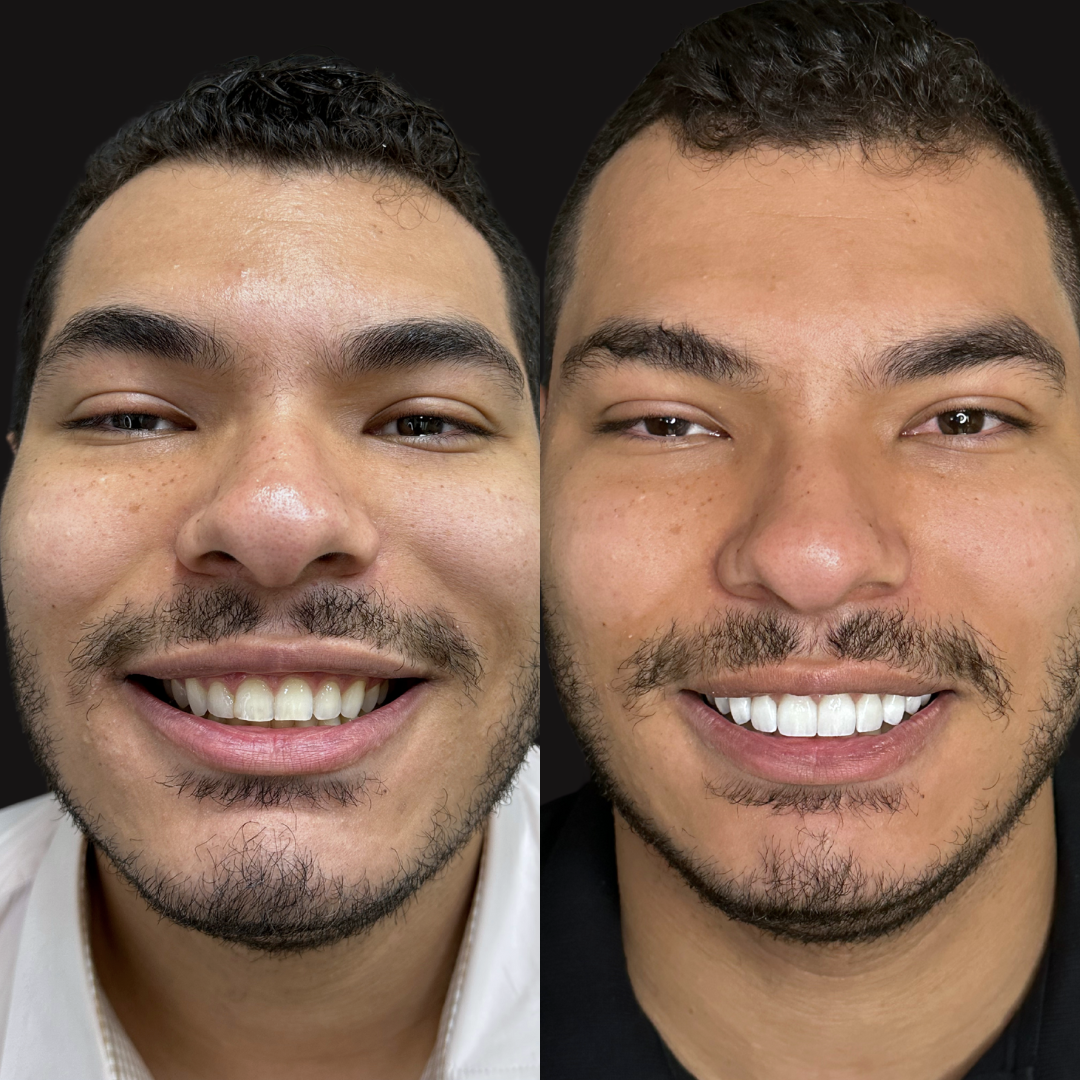 Lentes de Contato 1