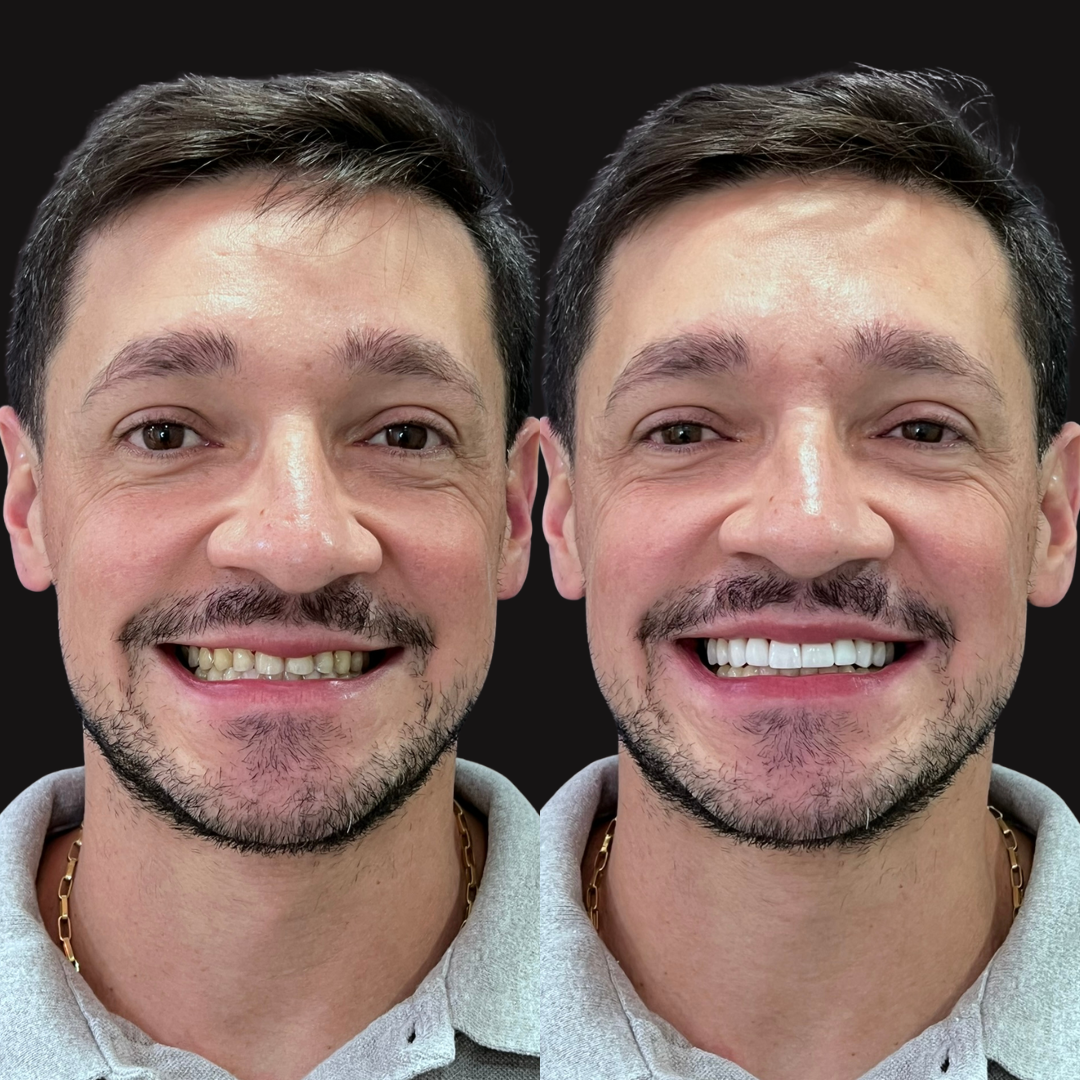 Lentes de Contato