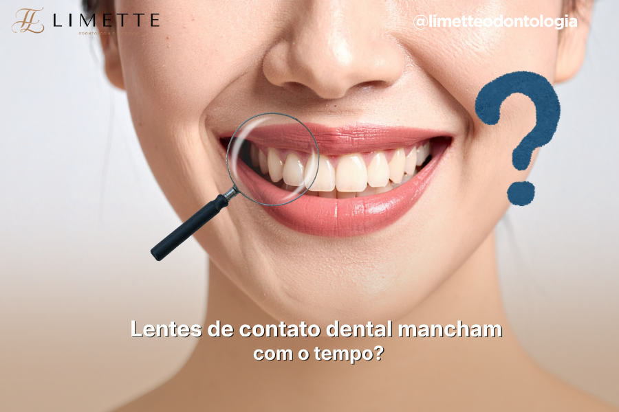 Lentes de contato dental mancham com o tempo?