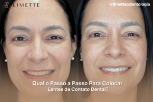 Lentes de Contato Dental