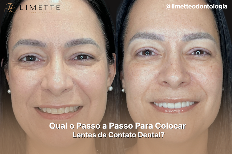 Lentes de Contato Dental