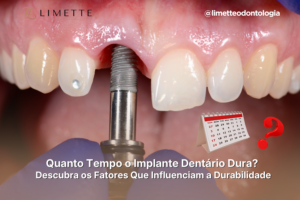 IMPLANTE DENTáRIO