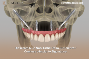 Disseram Que Não Tinha Osso Suficiente Para Implantes? Conheça o Implante Zigomático