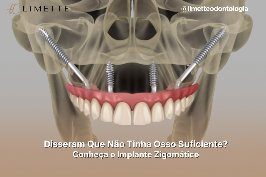 Disseram Que Não Tinha Osso Suficiente Para Implantes? Conheça o Implante Zigomático