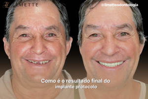 Como é o resultado final do implante protocolo
