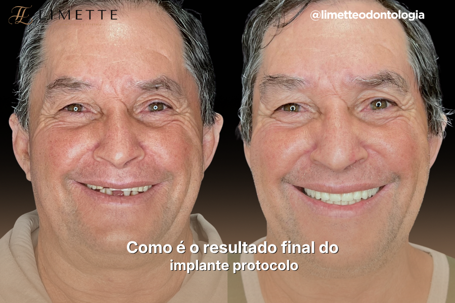 Como é o resultado final do implante protocolo