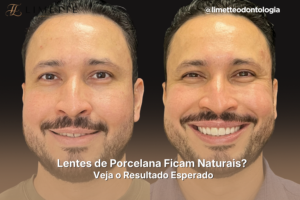 Lentes de porcelana