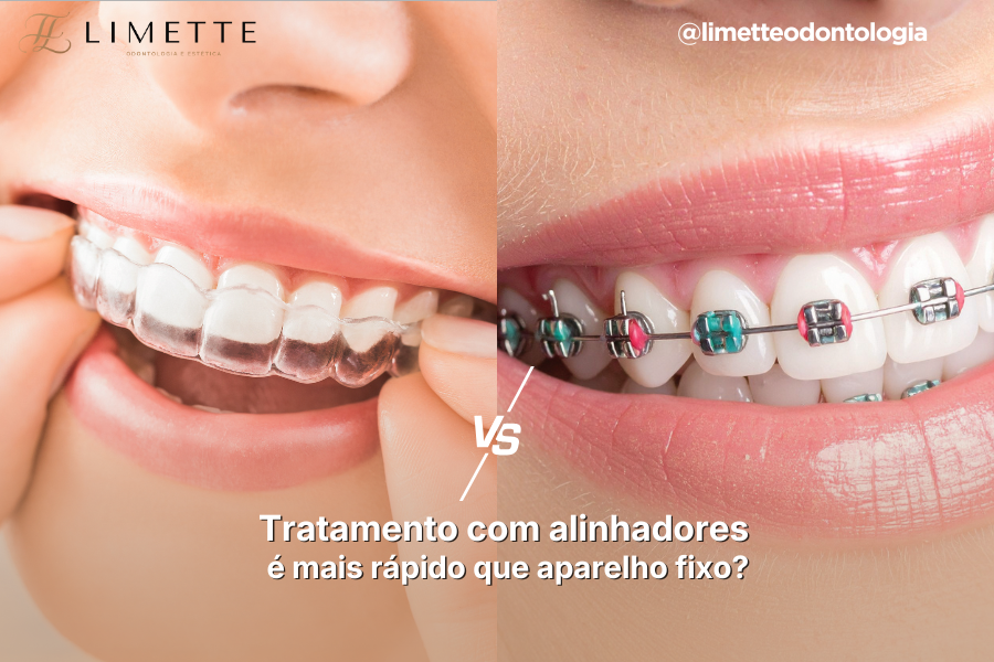 Tratamento com alinhadores é mais rápido que aparelho fixo?