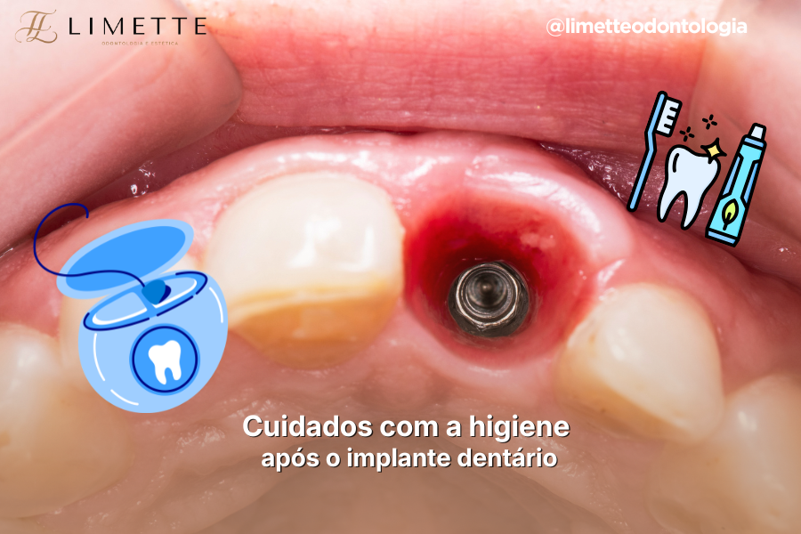 Cuidados com a higiene após o implante dentário