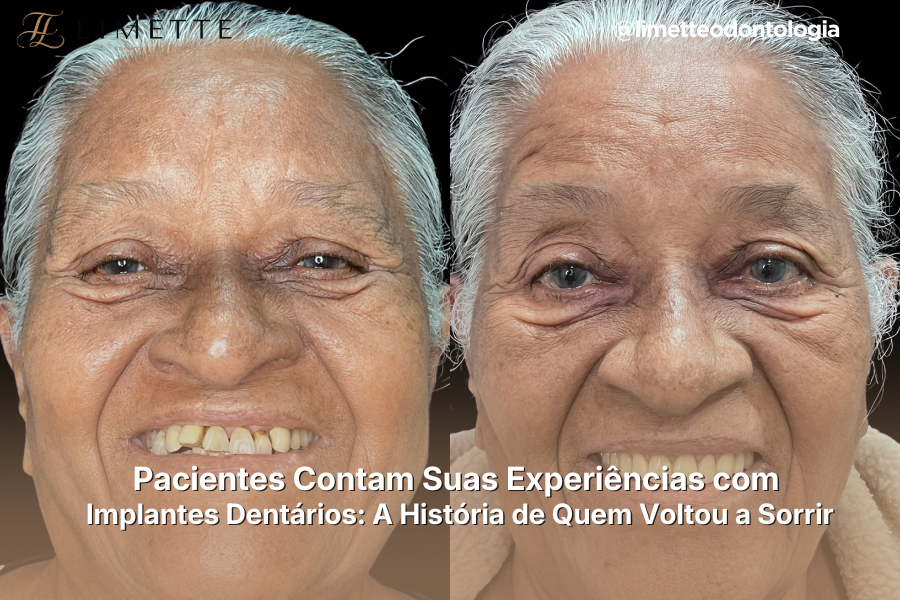 Pacientes Contam Suas Experiências com Implantes Dentários: A História de Quem Voltou a Sorrir