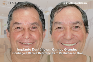 Implante Dentário em Campo Grande: Conheça a Clínica Referência em Reabilitação Oral