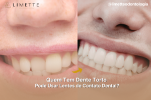 Quem Tem Dente Torto Pode Usar Lentes de Contato Dental?
