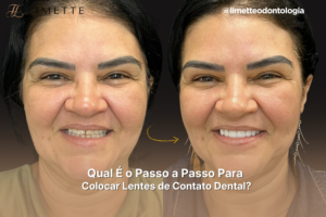 Qual É o Passo a Passo Para Colocar Lentes de Contato Dental?