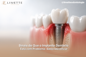 Sinais de Que o Implante Dentário Está com Problema: Saiba Identificar