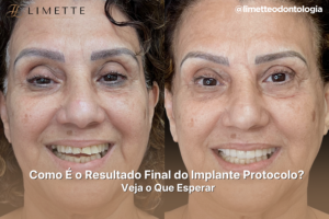 Como É o Resultado Final do Implante Protocolo? Veja o Que Esperar