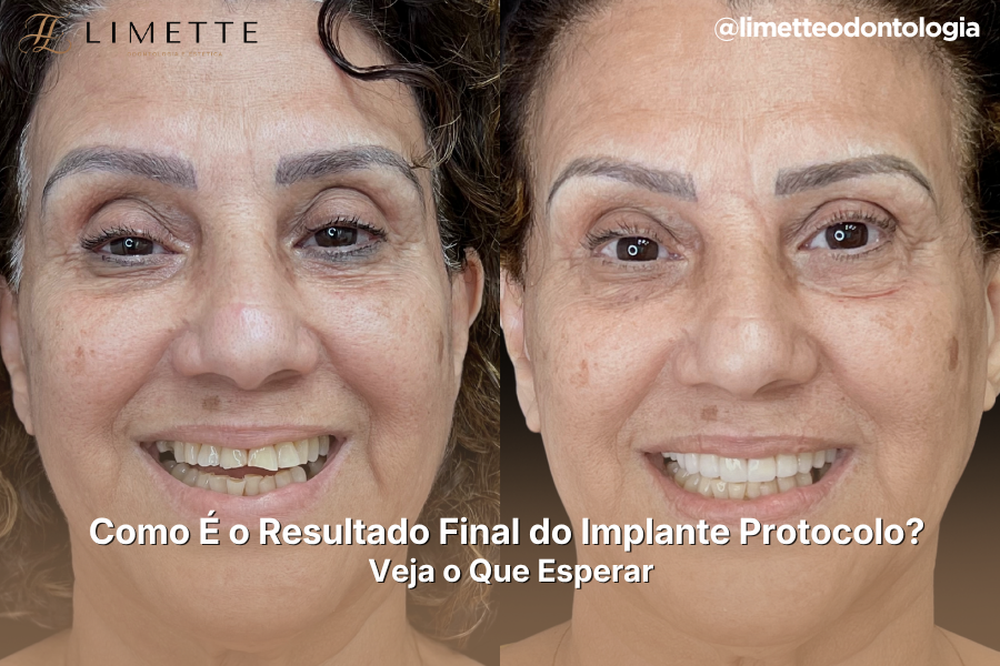 Como É o Resultado Final do Implante Protocolo? Veja o Que Esperar