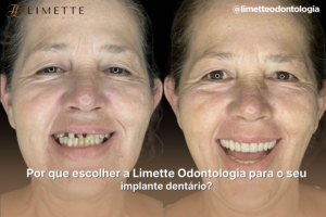 Por que escolher a Limette Odontologia para o seu implante dentário?