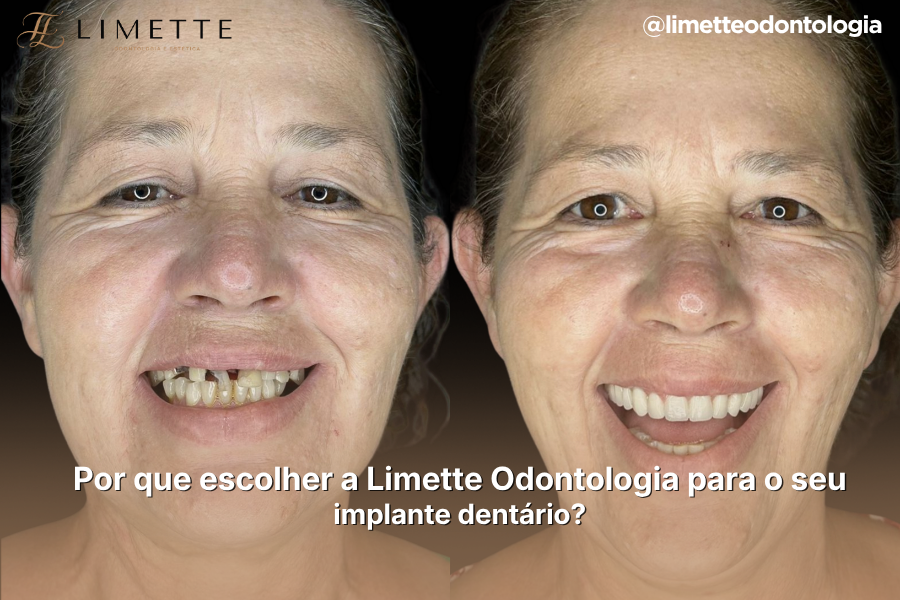 Por que escolher a Limette Odontologia para o seu implante dentário?