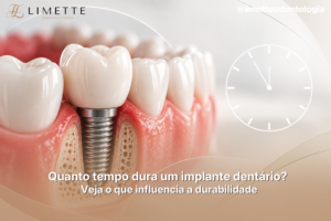 Quanto tempo dura um implante dentário? Veja o que influencia a durabilidade