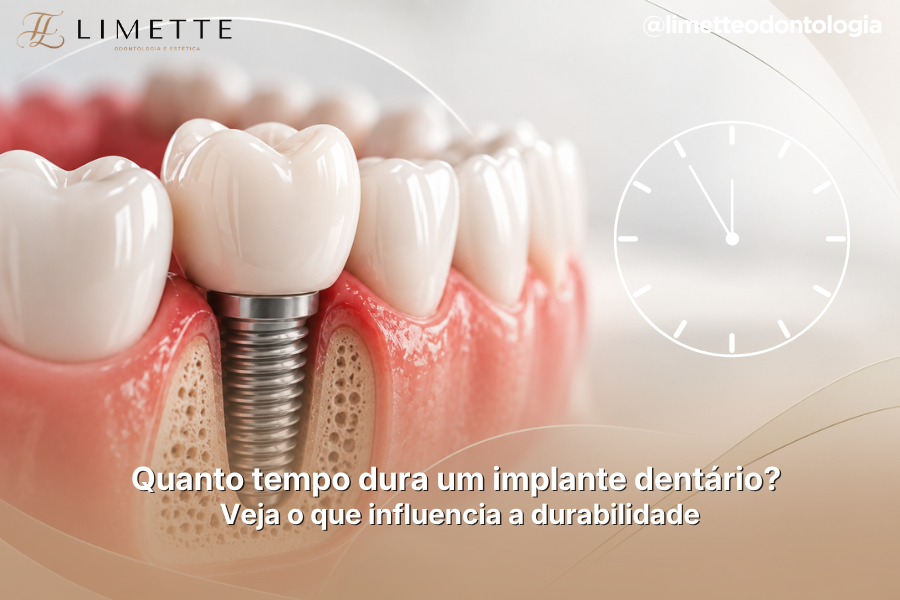 Quanto tempo dura um implante dentário? Veja o que influencia a durabilidade