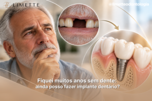 Fiquei muitos anos sem dente: ainda posso fazer implante dentário?