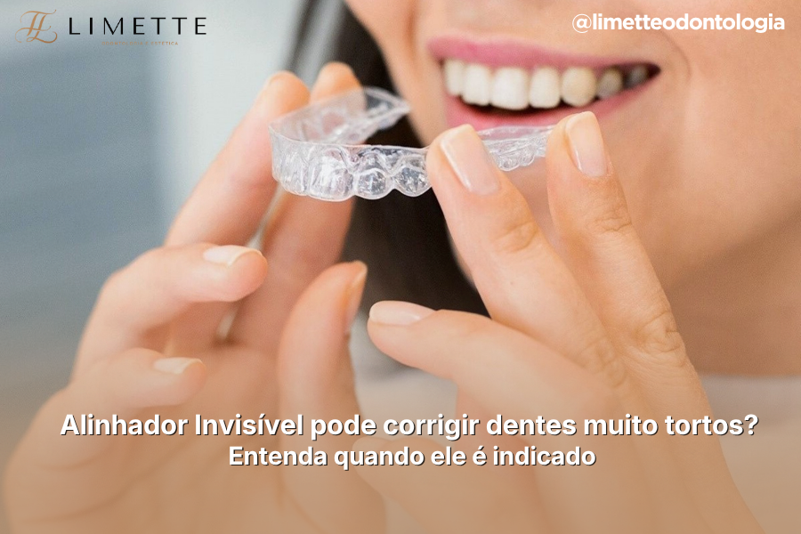 Alinhador Invisível pode corrigir dentes muito tortos? Entenda quando ele é indicado
