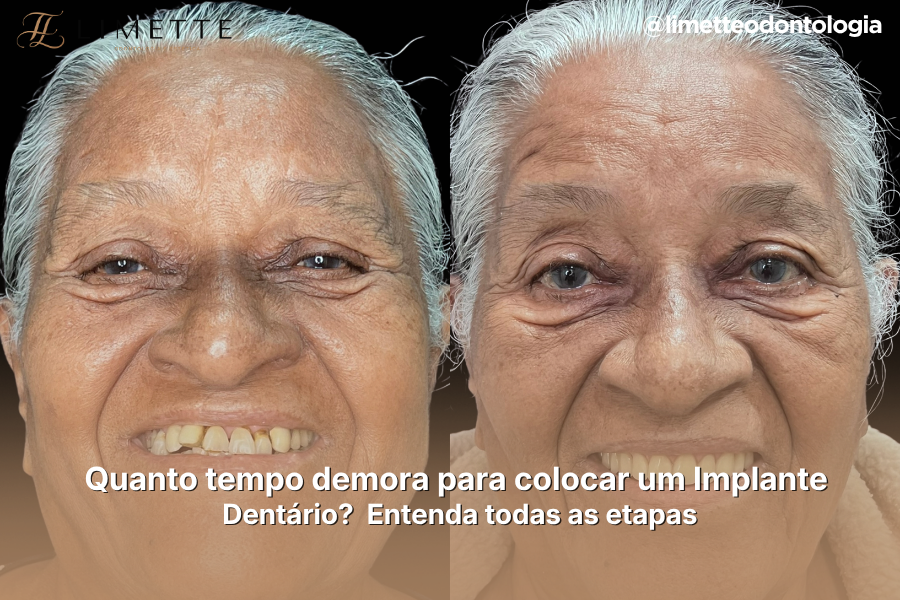 Quanto tempo demora para colocar um Implante Dentário? Entenda todas as etapas