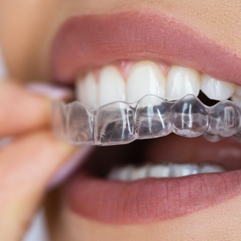 654b181472aae12be85debcf_sorriso-perfeito-invisalign-1200x630
