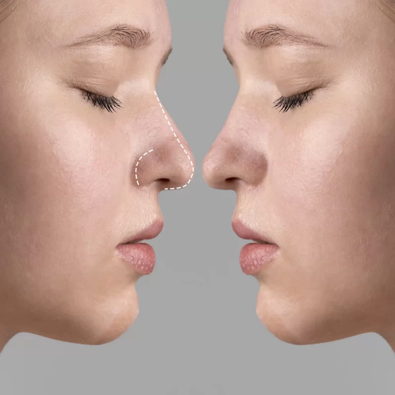 conceito-de-cirurgia-de-rinoplastia-com-modelo-de-mulher_1_11zon