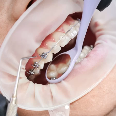 dentista-anexando-aparelhos-metalicos-aos-dentes-paciente