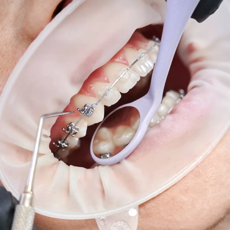 dentista-anexando-aparelhos-metalicos-aos-dentes-paciente