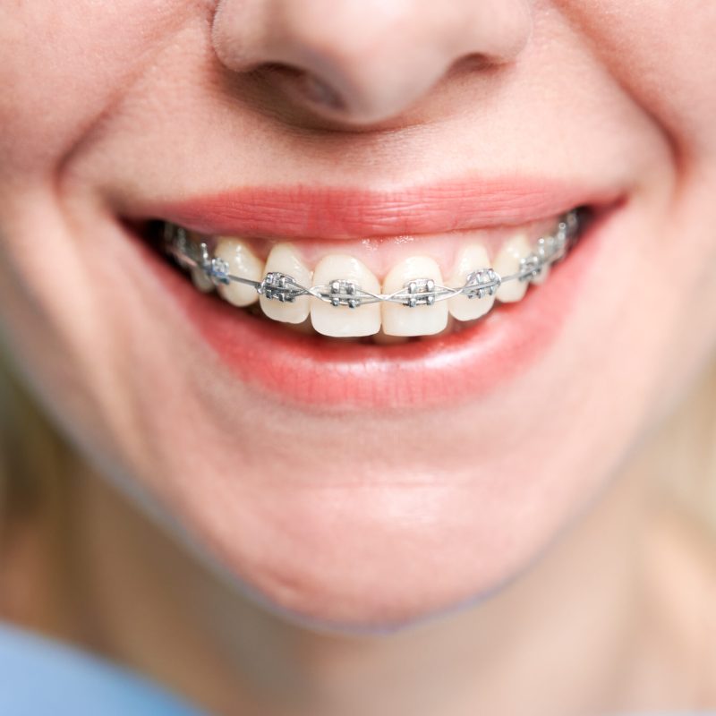Close up of woman with charming smile demonstrating white teeth with orthodontic brackets. Female patient showing results of dental braces treatment. Concept of orthodontic treatment and dentistry.