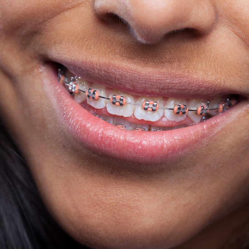 latin girl's mouth with brackets